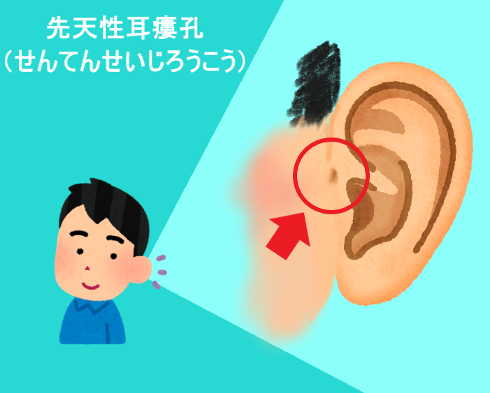 先天性耳瘻孔（せんてんせいじろうこう）　耳の付け根の穴